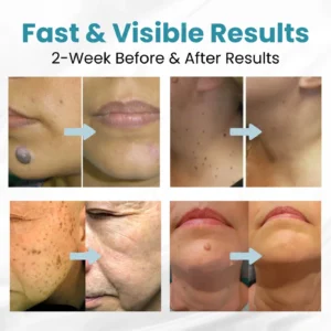 ACEZOZLA™ non-invasive laser pen delivers hospital-grade results at home