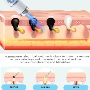 ACEZOZLA™ non-invasive laser pen delivers hospital-grade results at home