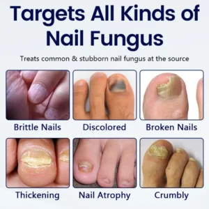 Acezozla® Anti-Fungal Nail Repair Patch