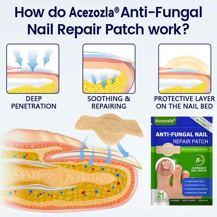 Acezozla® Anti-Fungal Nail Repair Patch