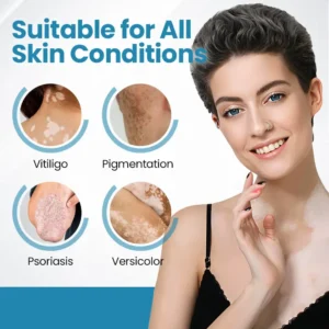 Acezozla® DermaBeam Vitiligo Therapy Device 3-5 Second Vitiligo Treatment, Visible Results in Just 2 Weeks