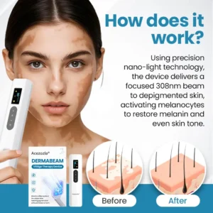 Acezozla® DermaBeam Vitiligo Therapy Device 3-5 Second Vitiligo Treatment, Visible Results in Just 2 Weeks