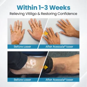 Acezozla® DermaBeam Vitiligo Therapy Device 3-5 Second Vitiligo Treatment, Visible Results in Just 2 Weeks