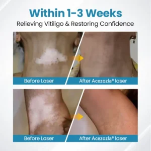Acezozla® DermaBeam Vitiligo Therapy Device 3-5 Second Vitiligo Treatment, Visible Results in Just 2 Weeks