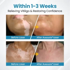 Acezozla® DermaBeam Vitiligo Therapy Device 3-5 Second Vitiligo Treatment, Visible Results in Just 2 Weeks