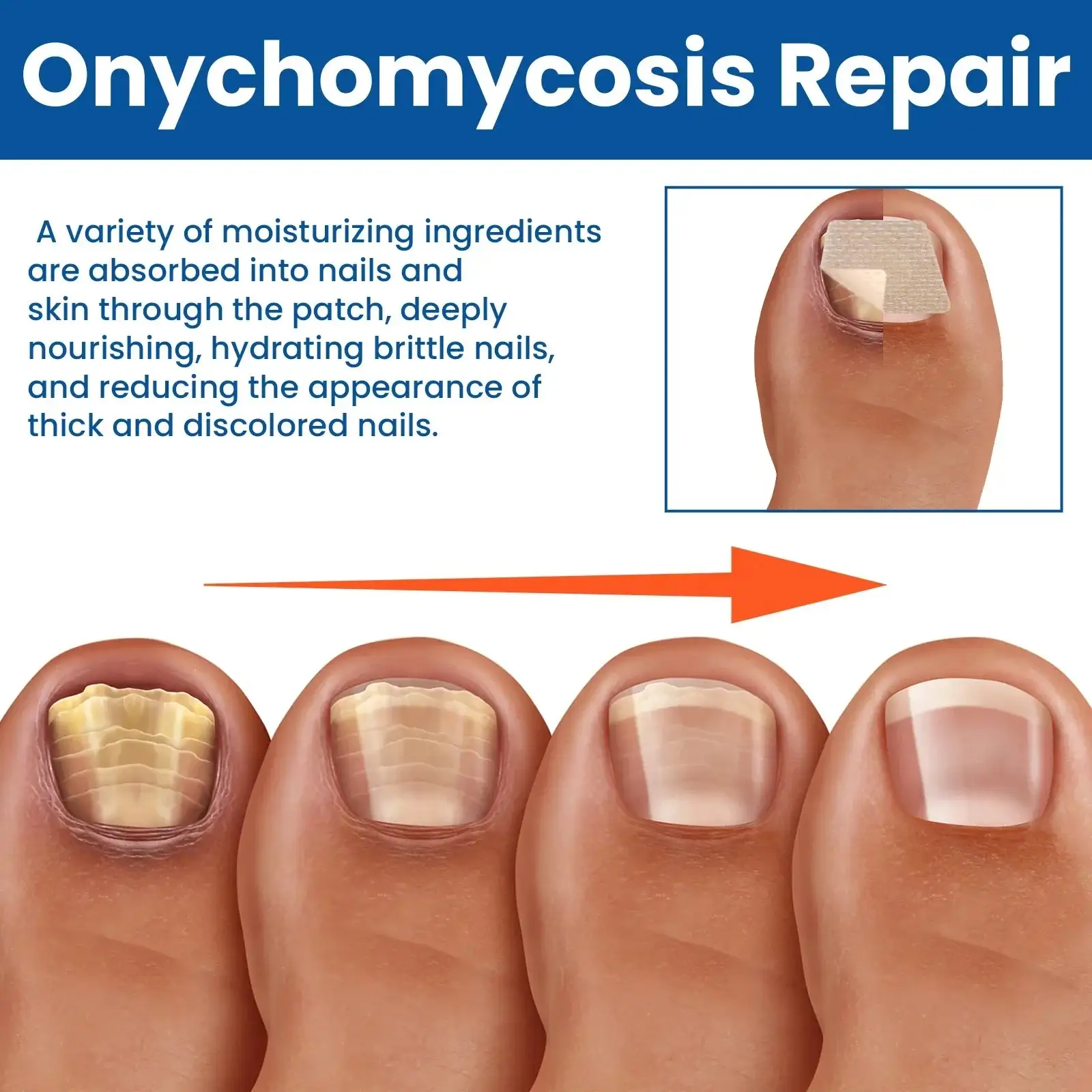 Acezozla® Fungus Nail Repair Patches