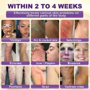 Made and Shipped from USA ✨Acezozla® Biotin 10-in-1 Skin Restoration Cream 🍀