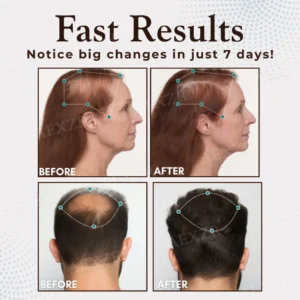 Acezozla™ Hair Regrowth Capsules💊Support Fast Hair Growth & Thicker Looking Hair✨