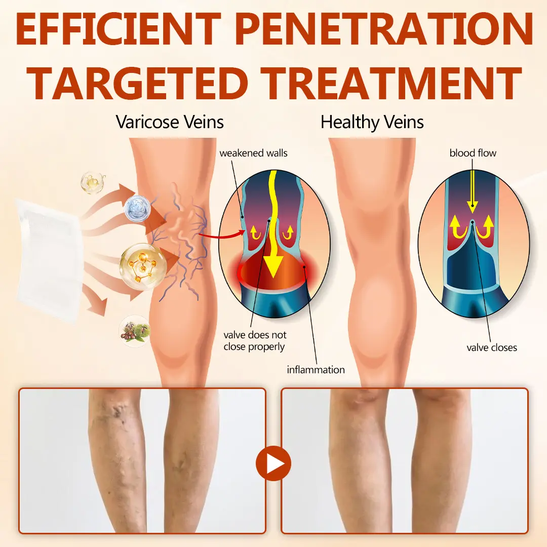 🔥 LIMITED SPECIAL OFFER🔥Acezozla® VeinRepair Microneedle Patch Roll (Advanced Microneedle Vein Repair Patch for Bulging Veins, Swelling, Heavy Legs & Daily Leg Discomfort)